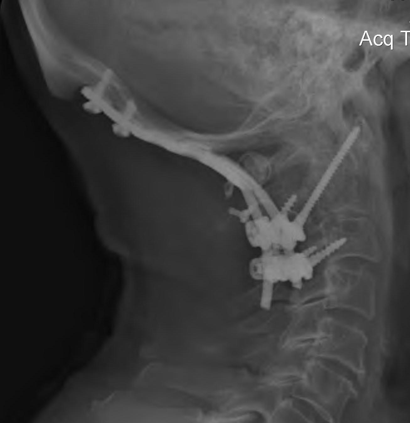 Occipital Cervical Fusion Lateral